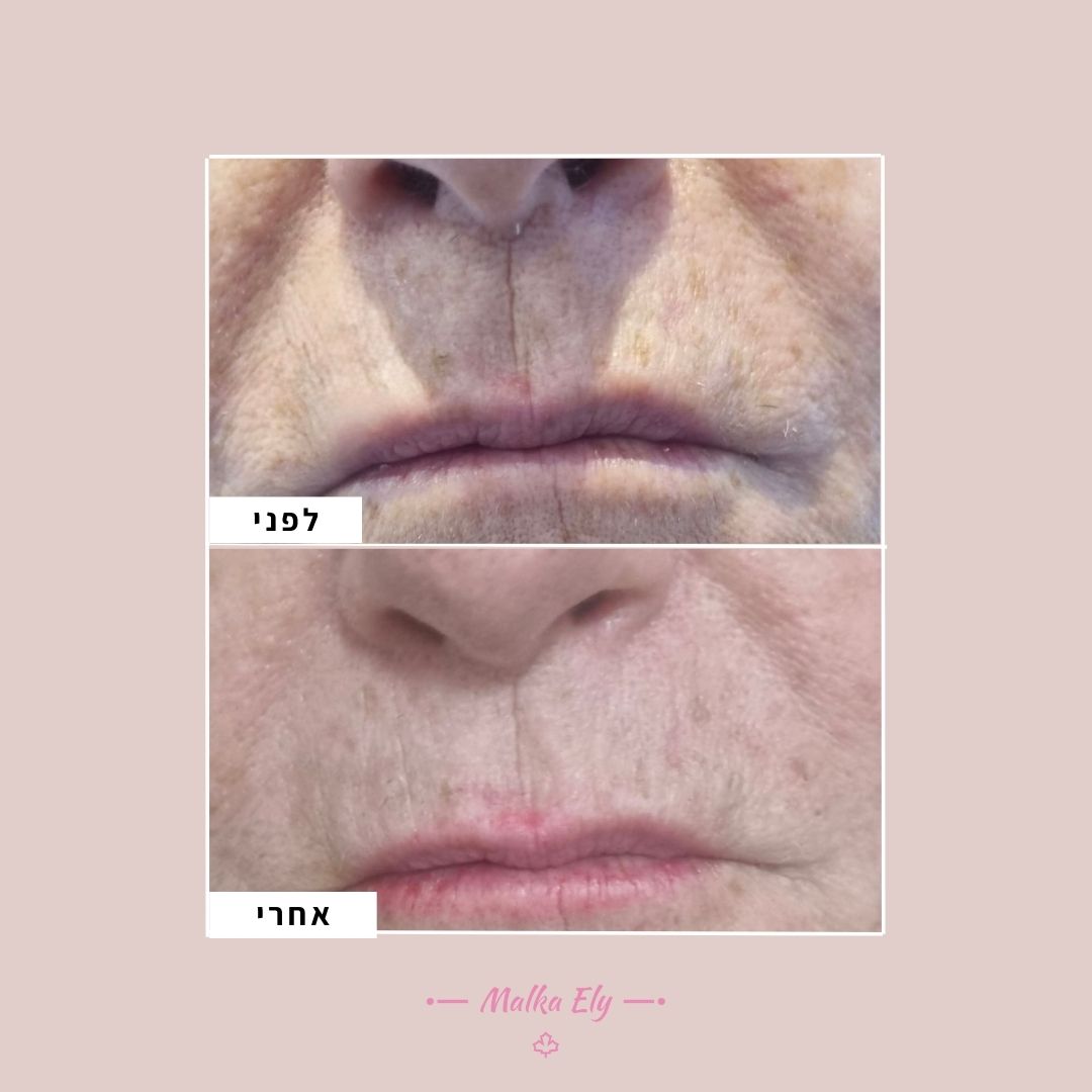 פלזמה לפני ואחרי